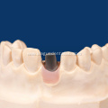 Custom Abutment with Two Brand New Screws